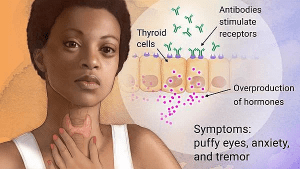 Diagram of thyroid cells and receptors, illustrating how stimulation leads to Graves' disease, with accompanying signs and symptoms such as puffy eyes