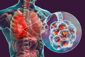 Diagram highlighting the lungs as the primary affected area in Legionnaires' disease, showing how the infection impacts lung tissues.