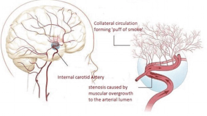 Diagram illustrating stenosis in the brain leading to Moyamoya disease. Visual representation of how narrowed arteries affect blood flow.