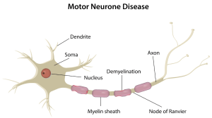 Image showing a demyelinated neuron affected by motor neurone disease, highlighting loss of myelin sheath and nerve damage