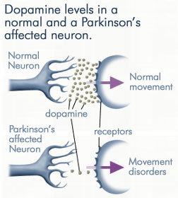 Comparison of dopamine levels in two neurons: a normal neuron versus a neuron affected by Parkinson's disease, with decreased dopamine levels in the latter