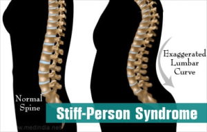 Diagram illustrating how Stiff Person Syndrome affects the spine, causing it to curve and become rigid
